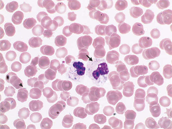 사진출처=bloodjournal.org