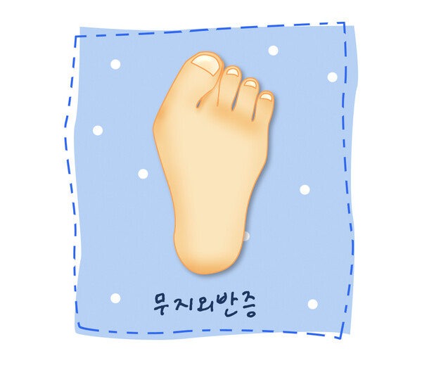 무지외반증(제공=힘찬병원)