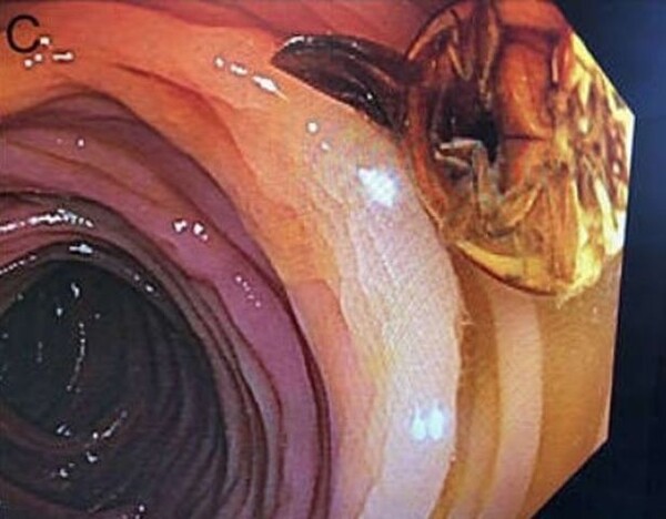 사진출처=American Journal of Gastroenterology