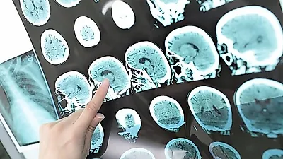 중풍으로 알고 있는 "뇌졸중" 발생 원인과 증상