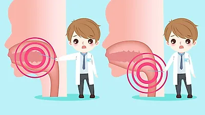 구내염증 혓바늘 돋는 원인과 치료법