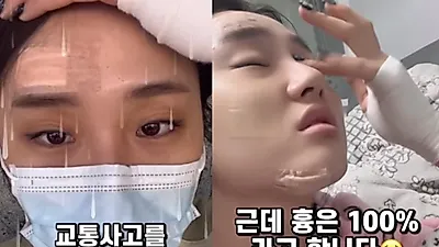 뇌진탕에 얼굴에 붕대 투성이…50만 유튜버 무슨 일?