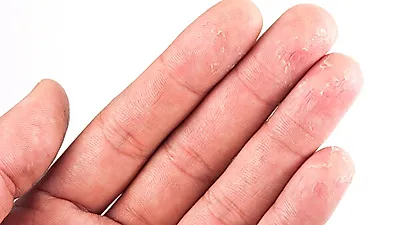 흔하지만 난치성 질환 '주부습진' 증상 완화법