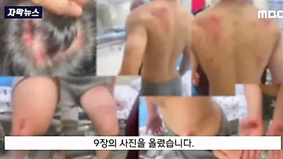 흉기 난동 오해 받아 온몸 피멍 든 중학생 근황 '충격'
