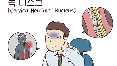나이와 상관없이 발생하는 목디스크 치료와 운동법