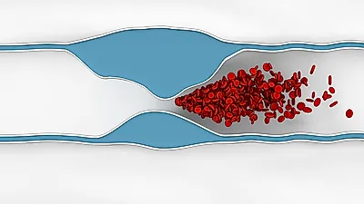 성인 6명 중 한 명 '고콜레스테롤혈증' 주의점은?