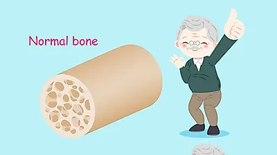 골다공증의 원인과 치료, 예방에 좋은 음식
