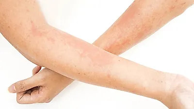 조선소 집단 피부질환, 도료에 포함된 과민성 물질이 원인인 것으로 밝혀져