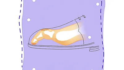 여름 철 못난 발 콤플렉스, 무지외반증•망치족지 극복 팁
