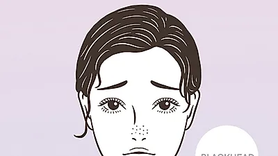 블랙헤드가 발생하는 이유와 제거 방법