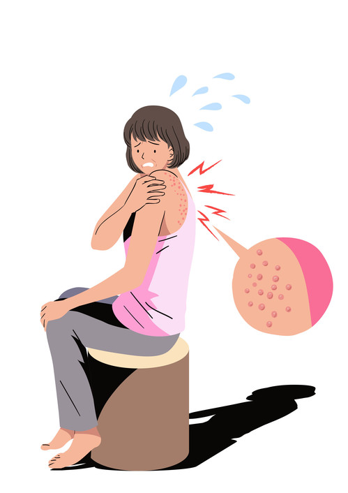 통증까지 발생하는 '대상포진' 치료 및 예방법