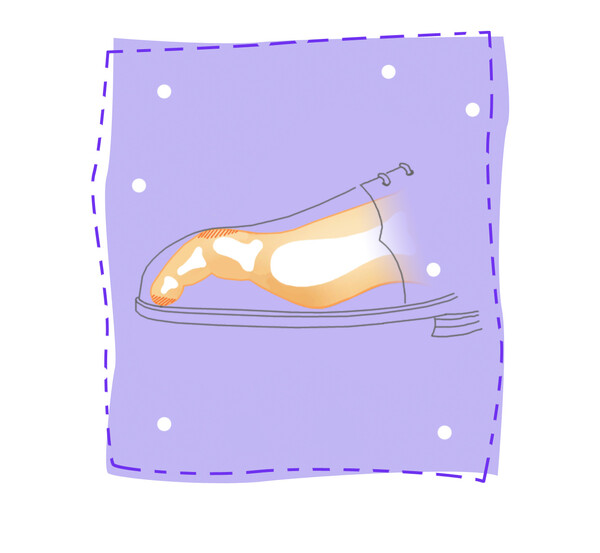 여름 철 못난 발 콤플렉스, 무지외반증•망치족지 극복 팁