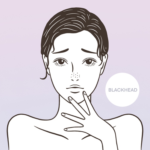 블랙헤드가 발생하는 이유와 제거 방법