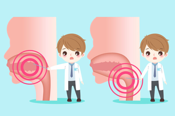 구내염증 혓바늘 돋는 원인과 치료법