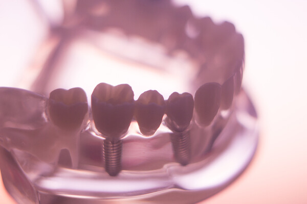 임플란트 주위염 원인과 증상, 예방법