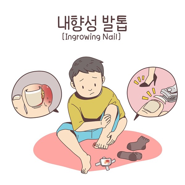 발톱으로 보는 건강 상태