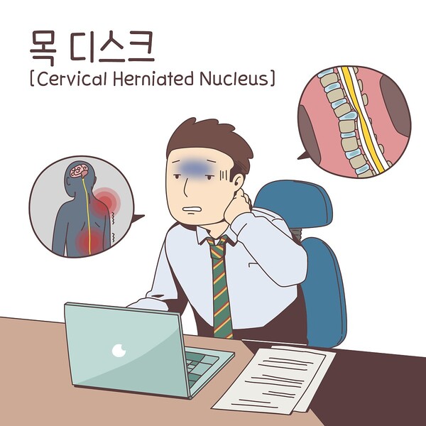 나이와 상관없이 발생하는 목디스크 치료와 운동법