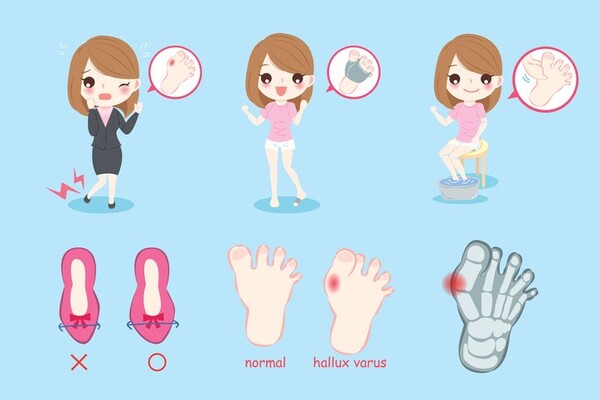 발가락이 휘어지는 "무지외반증" 원인과 증상 예방법