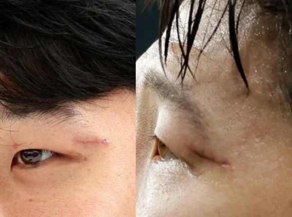 손흥민, 몸 상태 '충격' 상처 점점 심해져 