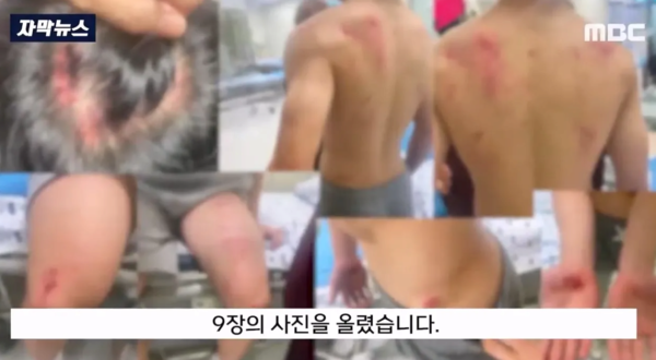 흉기 난동 오해 받아 온몸 피멍 든 중학생 근황 '충격'